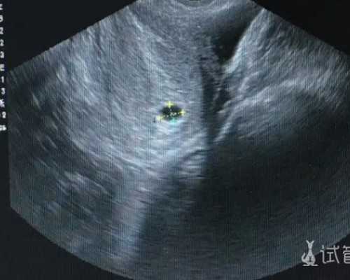 国内单身男找代生,北医三院试管婴儿费用大约多少2026年